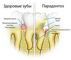 парондонтоз, стоматология